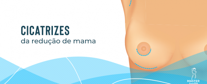 Conheça as cicatrizes da redução de mama