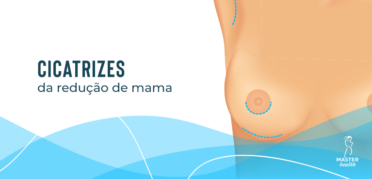 Conheça as cicatrizes da redução de mama