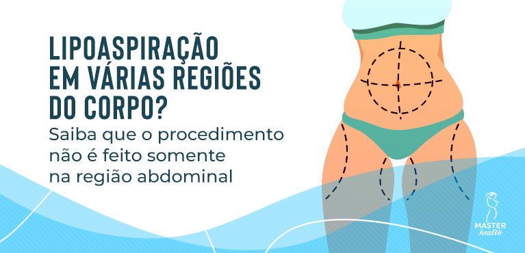 Parte do corpo feminino mostrando que é possível fazer a lipoaspiração em várias regiões do corpo