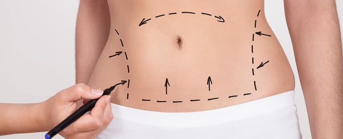 prepare-se para a sua abdominoplastia