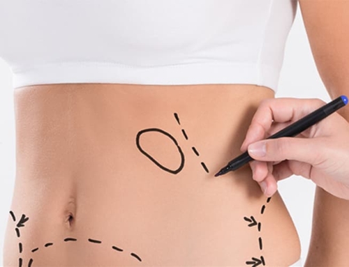 Segurança na lipoaspiração: como encontrar o profissional ideal?