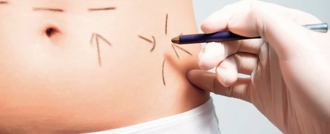 saiba como identificar segurança no cirurgião que fará a sua abdominoplastia