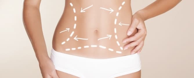 5 dúvidas e respostas sobre lipoaspiração!
