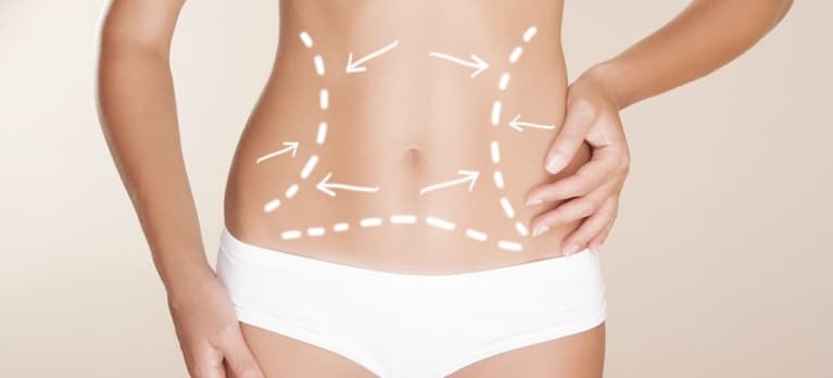 5 dúvidas e respostas sobre lipoaspiração!