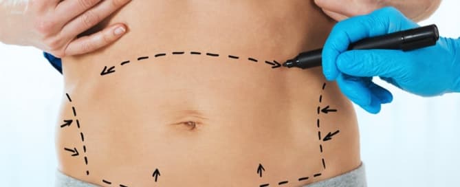 associar a abdominoplastia com lipoaspiração