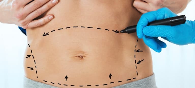 associar a abdominoplastia com lipoaspiração