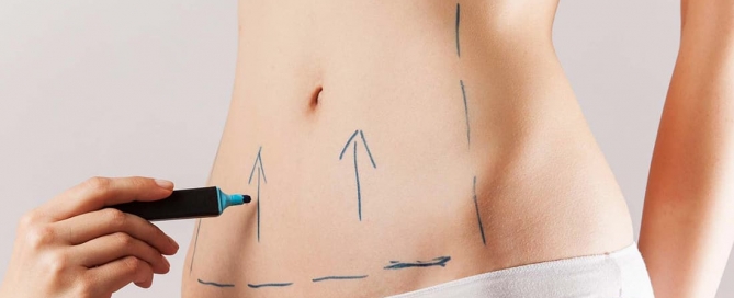 mitos sobre abdominoplastia