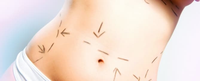 Lipoaspiração faz milagre