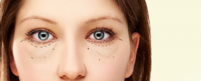Benefícios da blefaroplastia