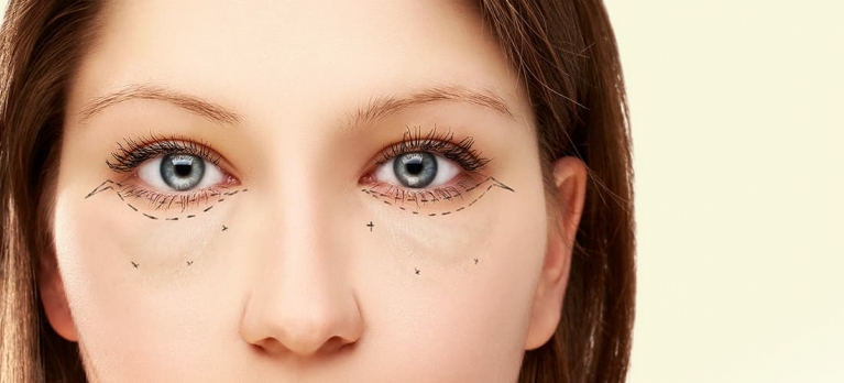 Benefícios da blefaroplastia