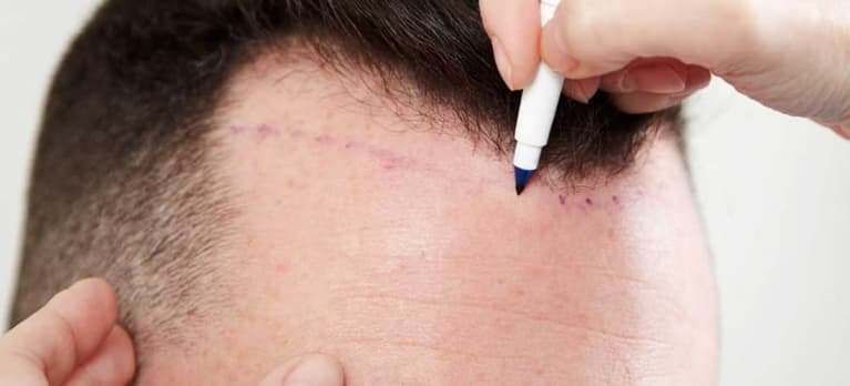 quanto tempo dura o transplante capilar