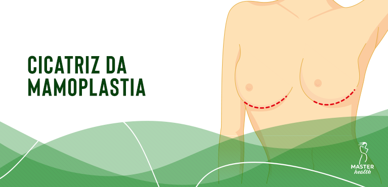 Cicatriz da mamoplastia
