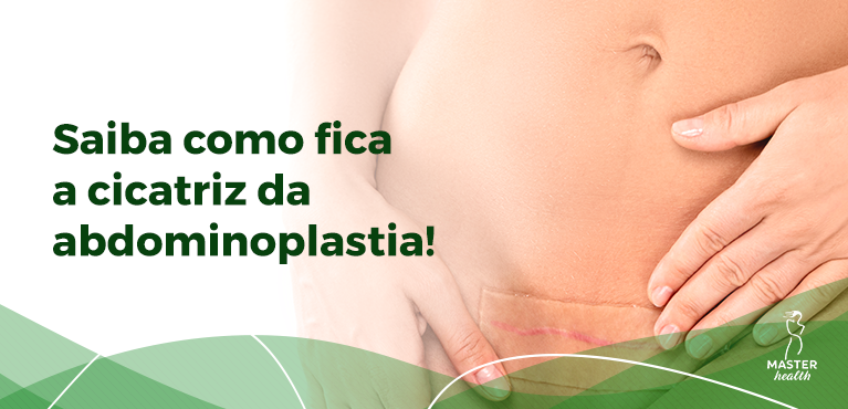 corpo de uma mulher com a cicatriz abdominoplastia