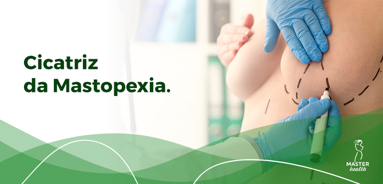 médico marcando seios da paciente para saber como vai ficar a mastopexia cicatriz final