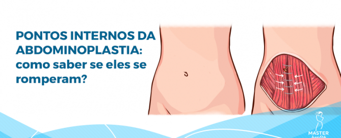 pontos internos da abdominoplastia