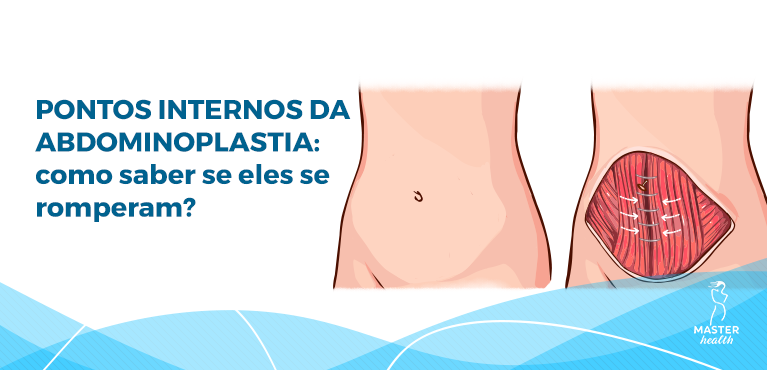 pontos internos da abdominoplastia