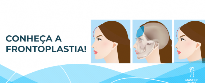 frontoplastia