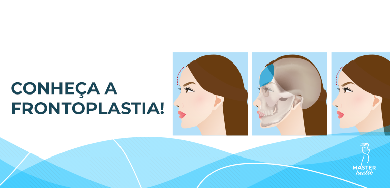frontoplastia