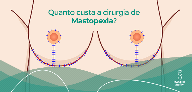 mastopexia valor