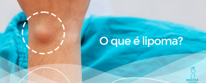 o que é lipoma
