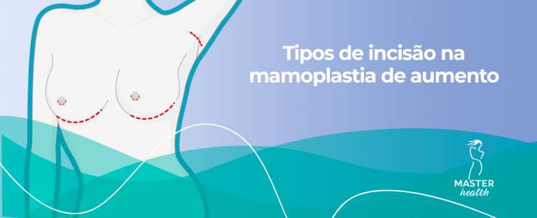 tipos de incisão