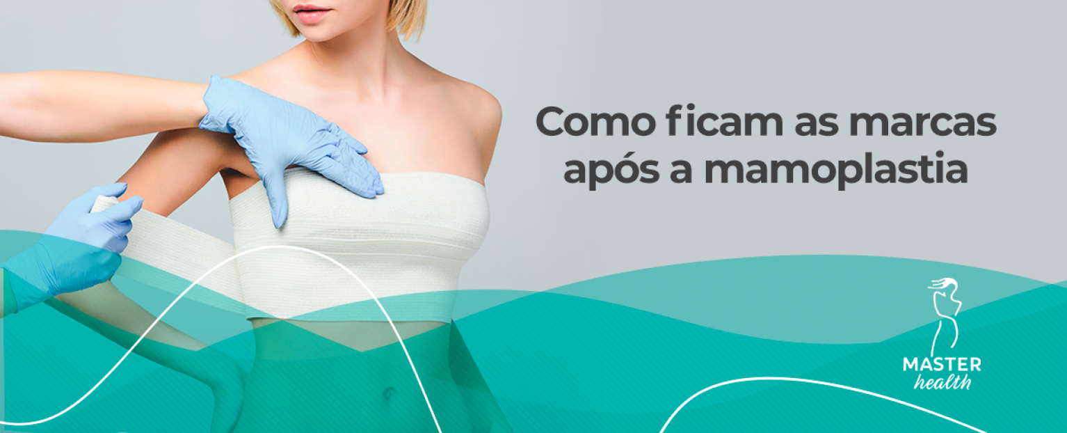Cicatriz da mamoplastia: como ficam as mamas? - Blog Master Health