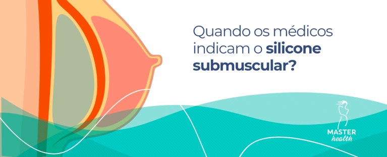ilustração da posição da prótese dentro do seio