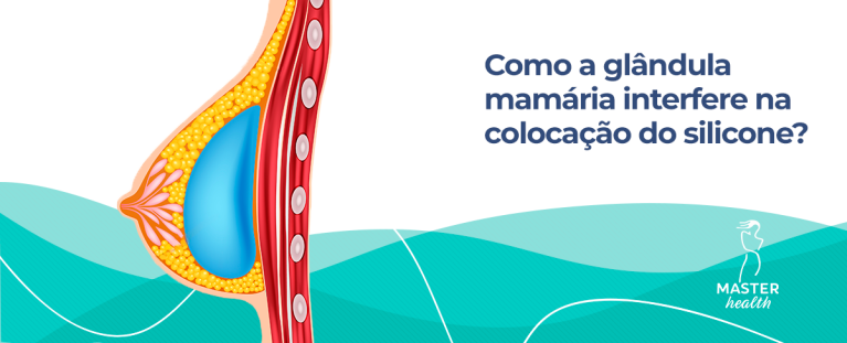 Ilustração mostrando como fica a prótese de silicone dentro do seio