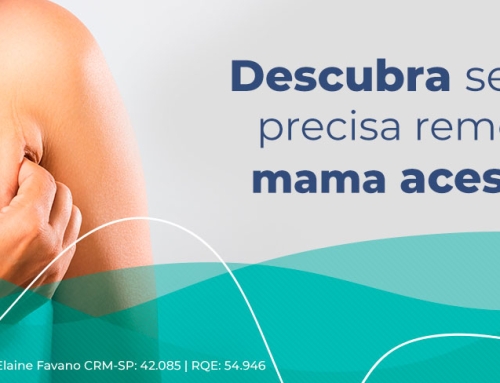 Mama acessória: o que é? Preciso retirar?