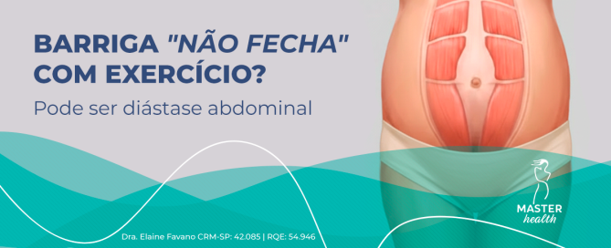 Ilustração mostrando o que seria uma diástase abdominal