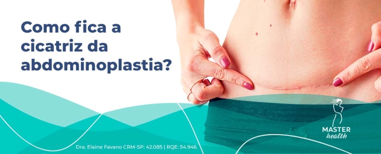 cicatriz abdominoplastia como fica
