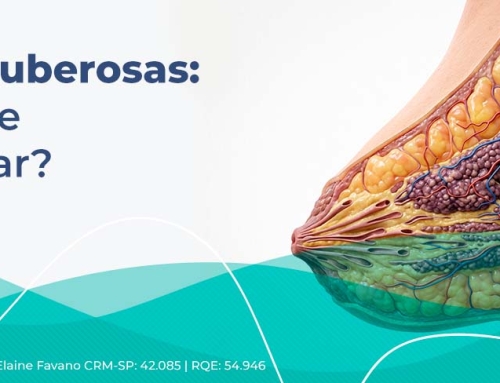 Mamas tuberosas: o que é essa alteração e como a cirurgia pode corrigir?
