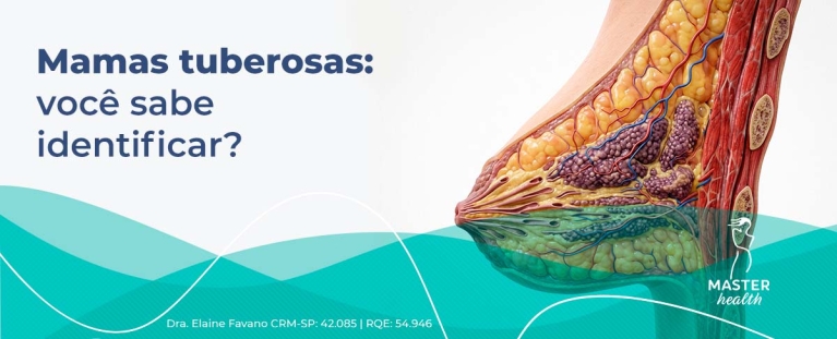 mamas tuberosas